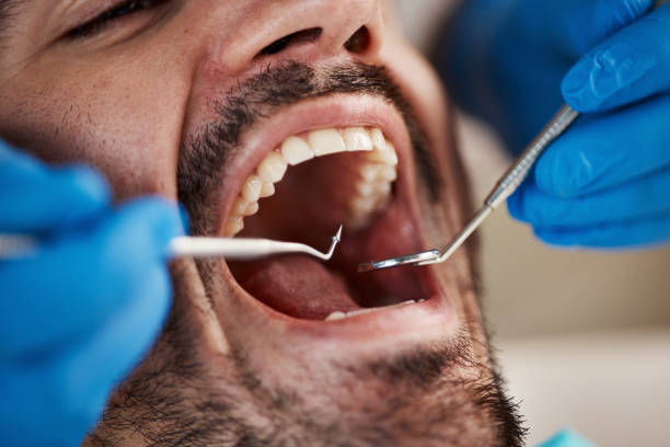 Best Emergency Dentist for Lost Fillings or Crowns in Lincolndale, NY